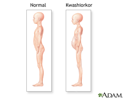 Síntomas de Kwashiorkor