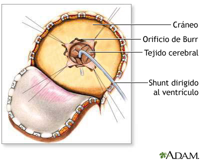 Craneotomía para derivación cerebral