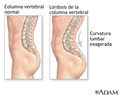 Lordosis