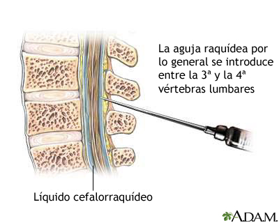 Punción lumbar