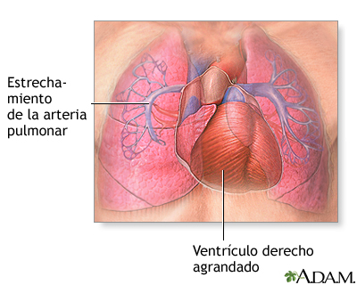 Hipertensión pulmonar primaria