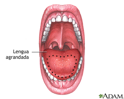 Macroglosia