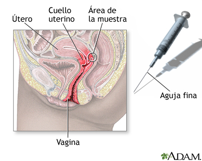 Toma de muestra con aguja del cuello uterino