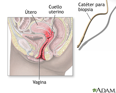 Biopsia de endometrio