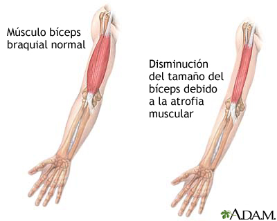 Atrofia muscular