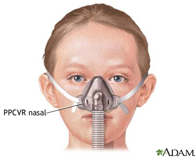 PPCVR Nasal