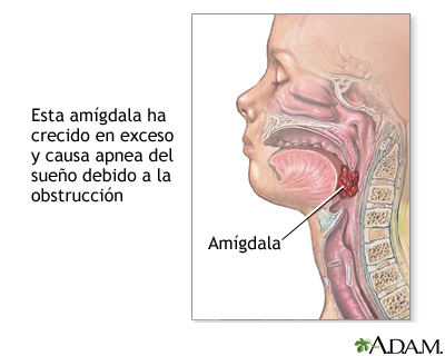 Apnea obstructiva del sueño