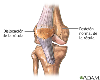 Dislocación de la rótula