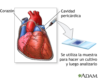 Tinción del líquido pericárdico