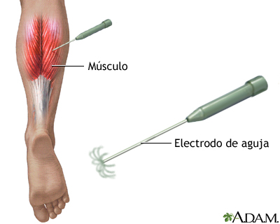 Electromiografía