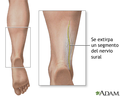 Biopsia de nervio