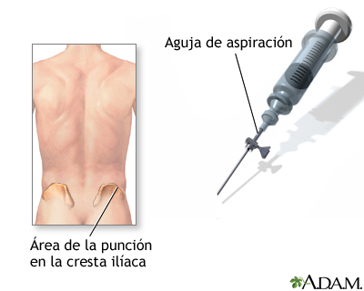 Biopsia de hueso