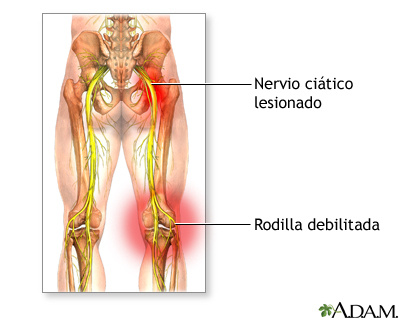 Daño al nervio ciático