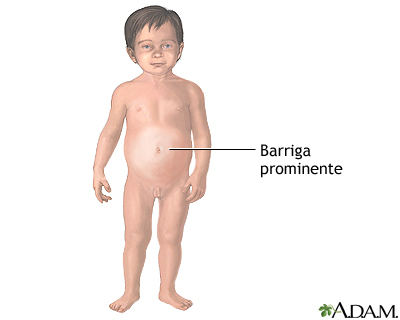 Niños barrigones