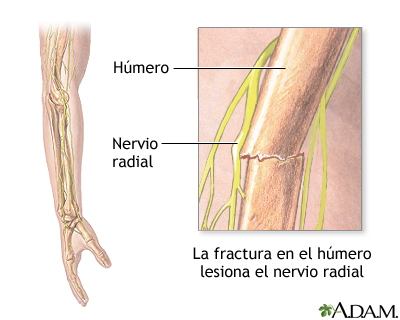 Disfunción del nervio radial