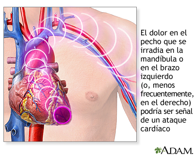 Síntomas de un ataque cardíaco