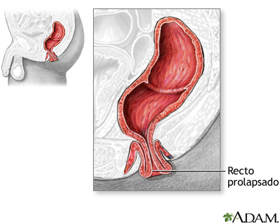 Prolapso rectal