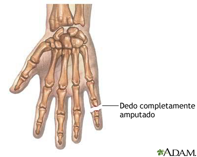 Dedo amputado