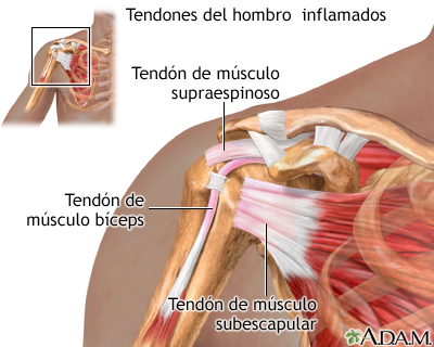 Tendones del hombro inflamados