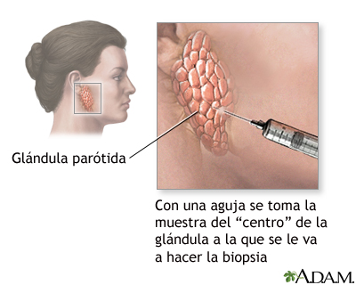 Biopsia de glándula salival