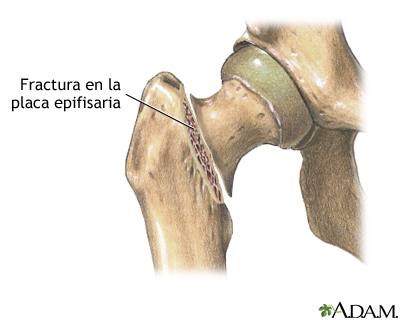 Fractura femoral