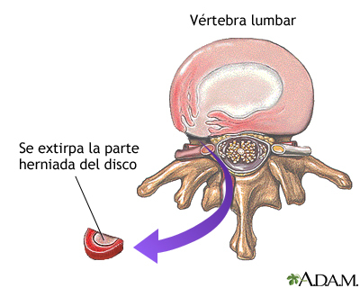 Reparación de un disco herniado