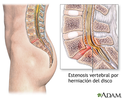 Estenosis espinal