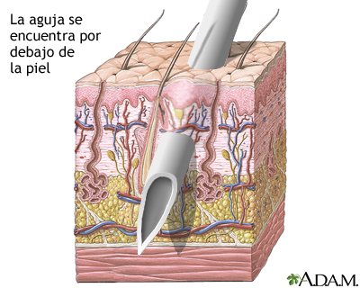 Capas de la piel y agujas