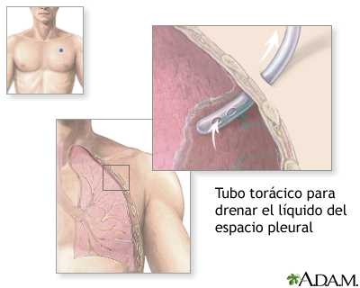 Inserción del tubo torácico