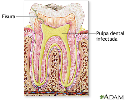 Absceso dental