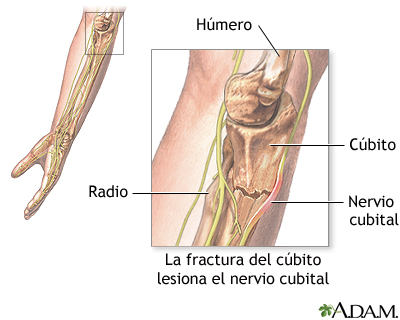 Daño del nervio cubital