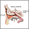 Ear tube insertion - series