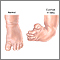 Club foot repair  - series