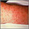 Rocky mountain spotted fever, lesions on arm