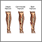 Bone fracture repair  - series