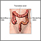 Large bowel resection - series