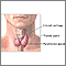 Parathyroidectomy - series