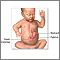 Pyloric stenosis - series