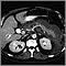 Pancreatitis, acute - CT scan