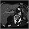 Adrenal metastases, CT scan