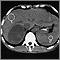 Tumor suprarrenal, tomografía computarizada