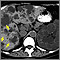 Kidney and liver cysts - CT scan