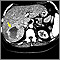 Hemangioma - CT scan