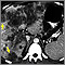 Hepatocellular cancer, CT scan