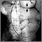 Ileus - X-ray of bowel distension