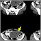 Intra-abdominal abscess, CT scan