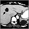 Liver and spleen cysts - CT scan