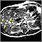 Melanoma of the liver - MRI scan