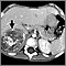 Neuroblastoma in the liver - CT scan