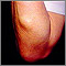 Lipoma - arm